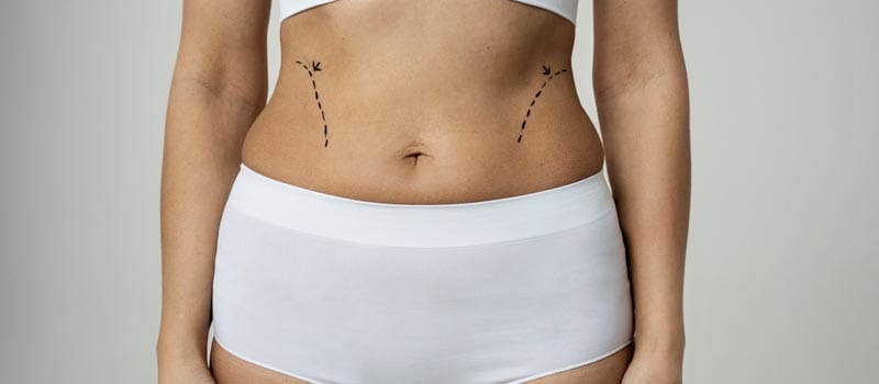 qué es la lipo 360