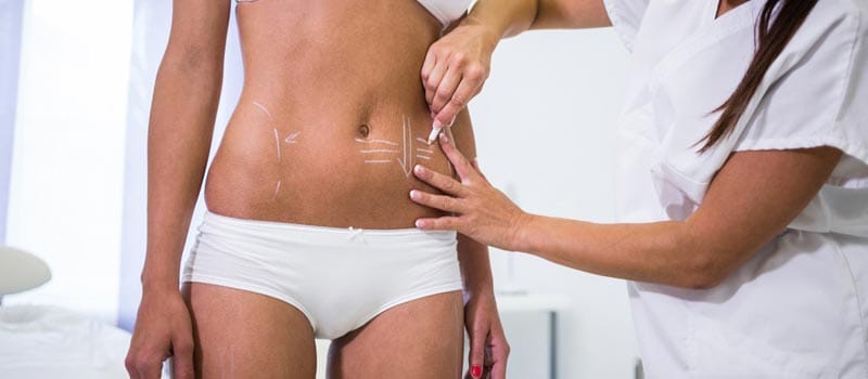 quién puede hacerse una lipo 360