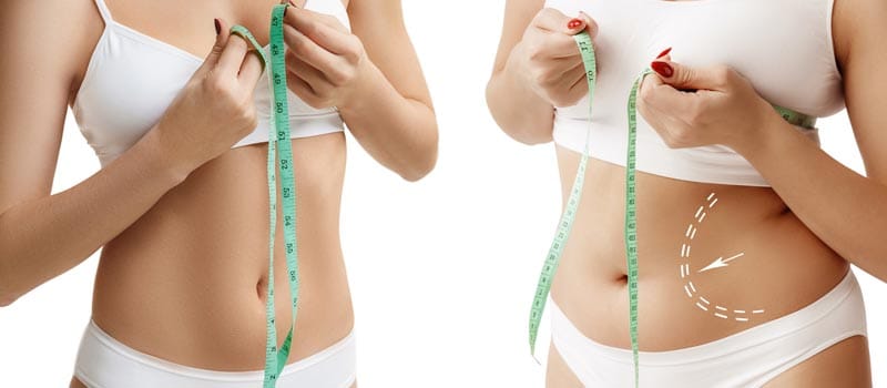 resultados cirugía mommy makeover