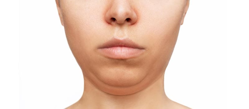 qué corrige una mentoplastia