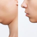 resultados de la mentoplastia