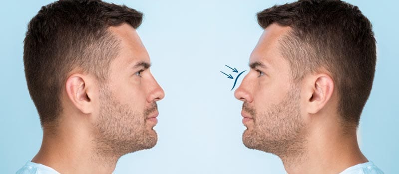 qué diferencia hay entre rinoplastia y alectomía