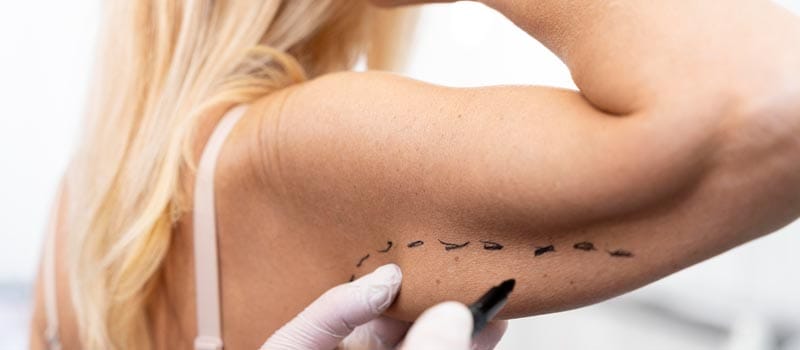 diferencia entre braquioplastia y liposucción de brazos